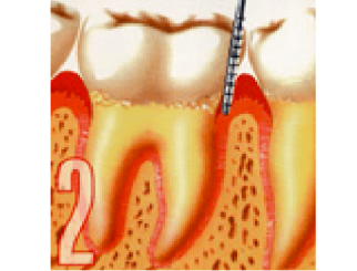 periodontia_estagio-2-322x245