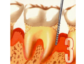 periodontia_estagio-3-322x245